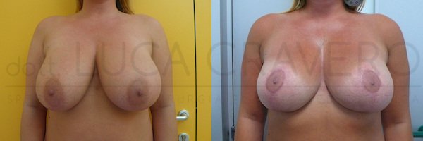 breast reduction before and after 16.10.18 - 1