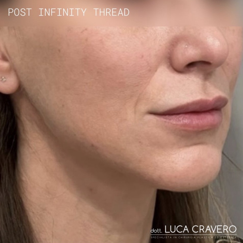 Lifting del viso e del collo con fili permanenti, prima e dopo
