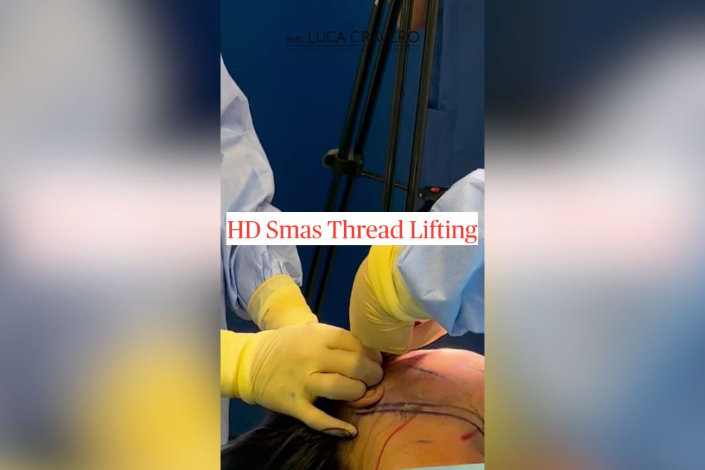 sala operatoria per un HDS thread lifting