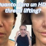 hds thread lifting torino dopo 3 anni