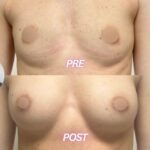 Il Recupero dell'Armonia Mammaria Post-Allattamento