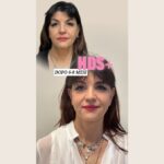Un caso a otto mesi: il collo dopo l'HDS Thread Lifting Plus