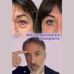 Blefaroplastica senza l'occhio scavato: trasposizione del grasso e lipofilling del solco