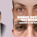 Borse palpebrali da giovani: quanto grasso togliere e quanto lasciarne