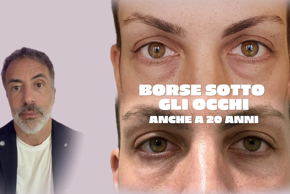 Borse palpebrali da giovani: quanto grasso togliere e quanto lasciarne