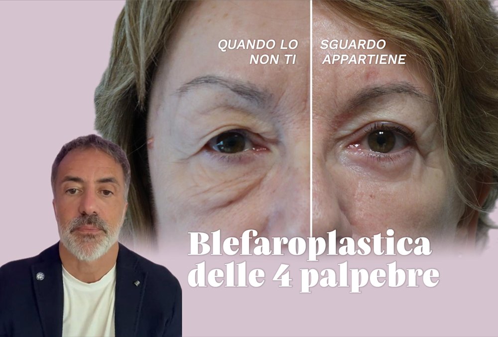 Il Dott. Luca Cravero spiega la blefaroplastica delle 4 palpebre con borse malari e terzo medio