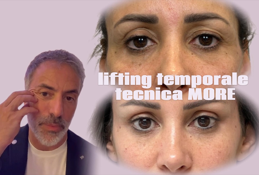 Il Dott. Luca Cravero mostra il gesto che orienta verso il lifting temporale